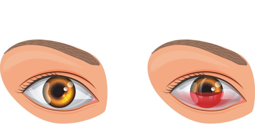 Среди травм глаз в отдельную категорию выделяют повреждение (травмы) роговицы глаза.