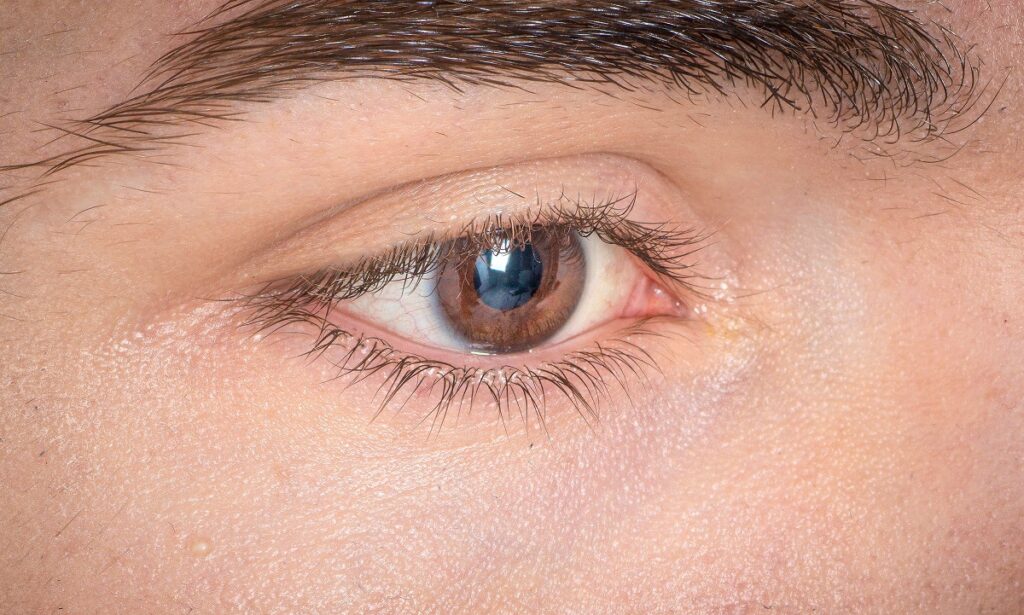 ЖКЛ (жесткие контактные линзы) — одни из первых приспособлений для улучшения зрения в виде примыкающих к глазам линз. Они предназначены для коррекции таких дефектов роговичного слоя как кератоконус, близорукость, дальнозоркость или астигматизм. Такие линзы восстанавливают деформацию роговицы, постепенно исправляя зрение.