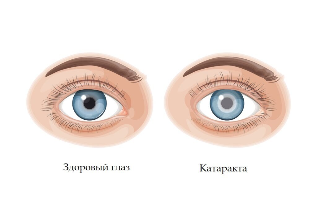 Факичные интраокулярные линзы являются современным и надежным методом лечения катаракты. Корректируют близорукость и способствуют сохранению целостности хрусталика глаза. 